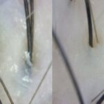 15 Step Stem Cell Scalp Treatment in Seoul - What Is Included and What Costs Extra?