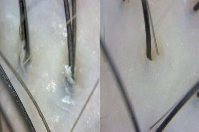 15 Step Stem Cell Scalp Treatment in Seoul - Is This Treatment Worth It?