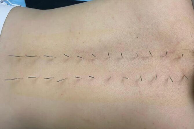 Acupuncture and Suction Cups Session at the Hospital - The Practicalities: What You Need to Know